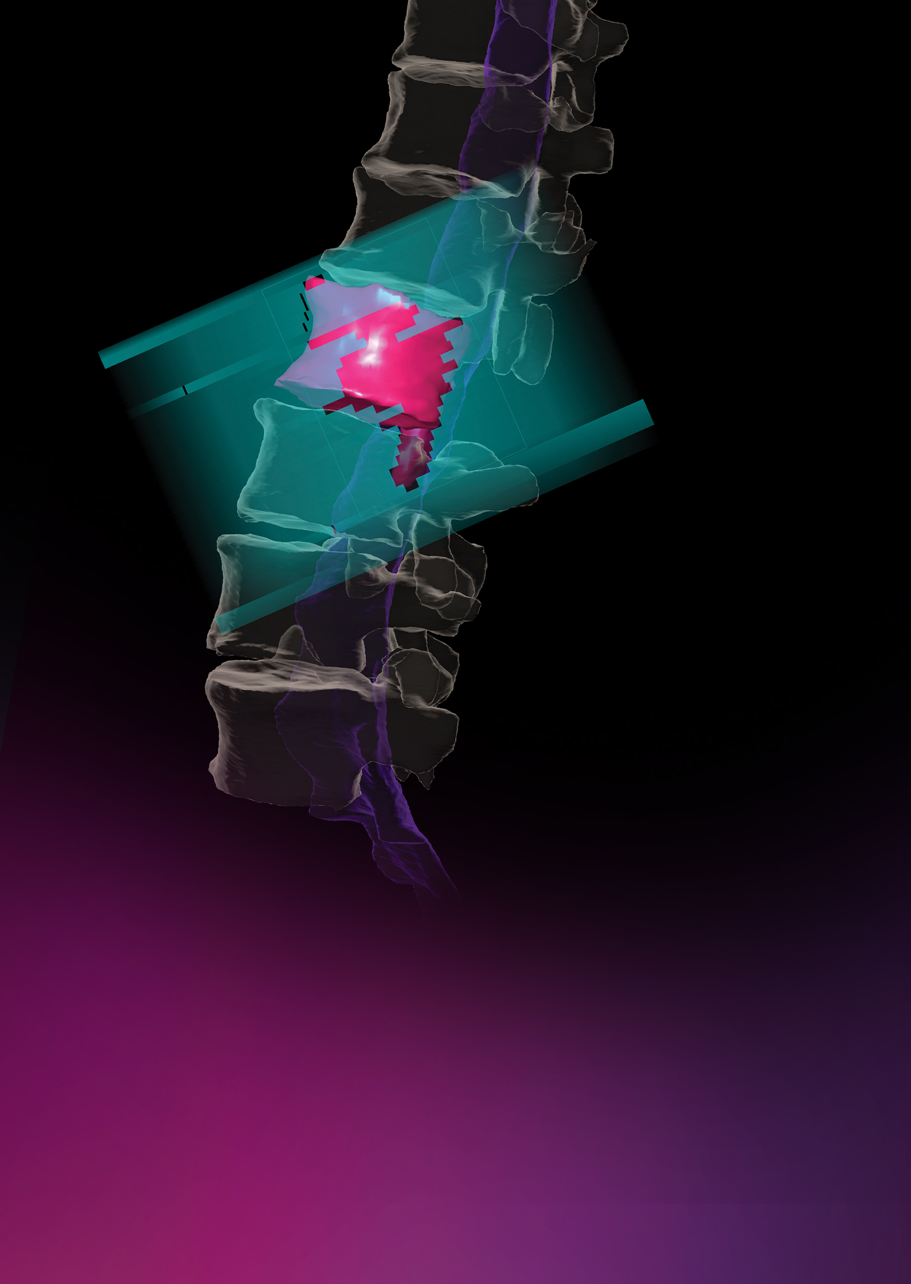 Elements Spine SRS: Spine Metastases Planning | Brainlab
